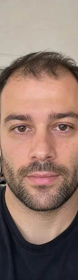 Grant H., 33, before: hairline & temples