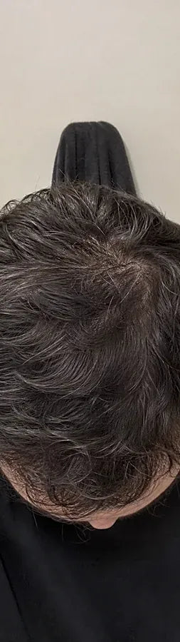 Caleb S., 32, after: crown thinning