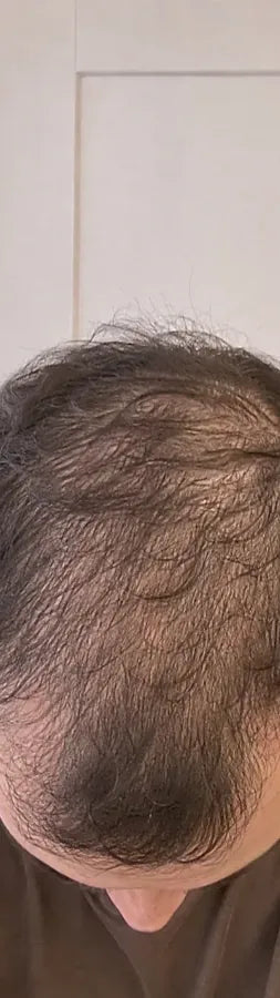 Caleb S., 32, before: crown thinning