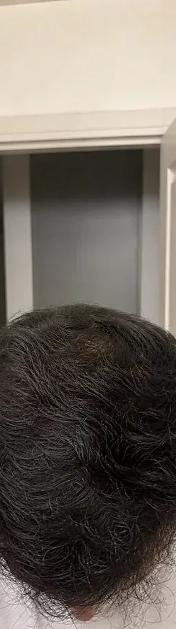 Travis L., 40, after: vertex thinning