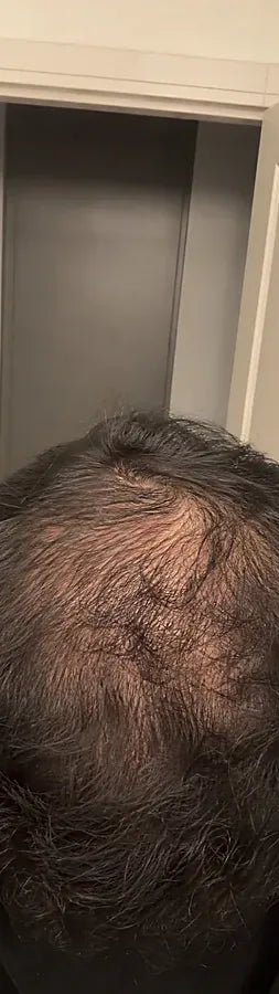 Travis L., 40, before: vertex thinning