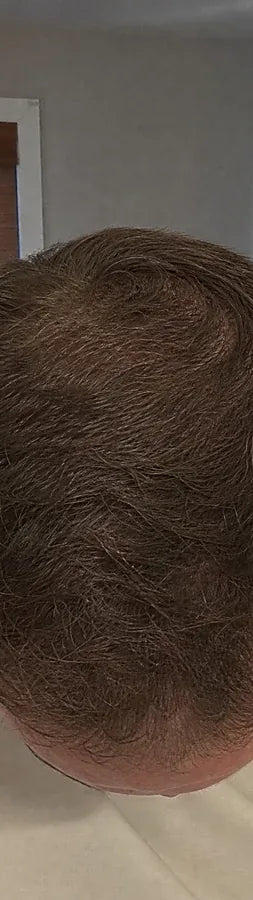 Wes A., 47, after: crown thinning