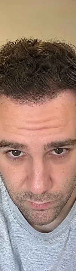 Colin R., 37, after: frontal thinning