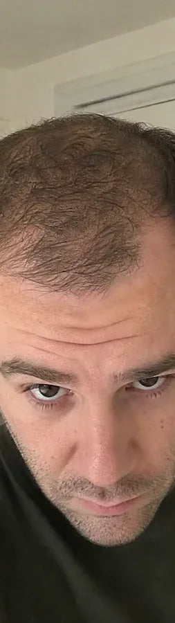Colin R., 37, before: frontal thinning