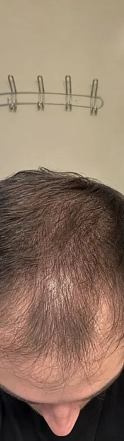 Peter V., 42, before: crown & mid-scalp