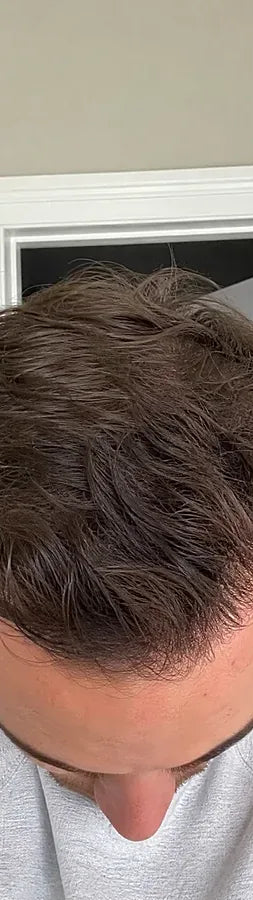 Sean M., 35, after: vertex thinning