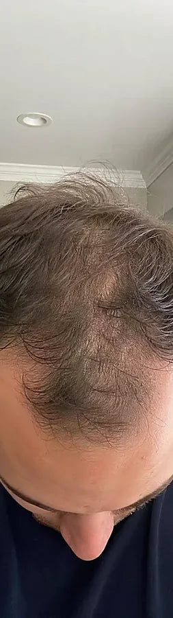 Sean M., 35, before: vertex thinning