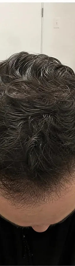 Adam T., 31, after: crown thinning