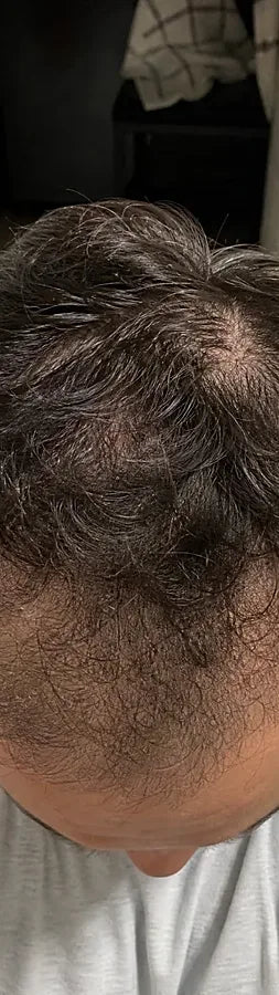 Adam T., 31, before: crown thinning