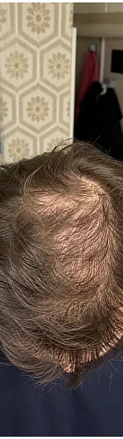 Miles C., 45, before: diffuse thinning