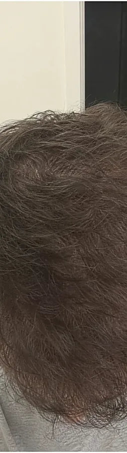 Josh N., 29, after: crown thinning