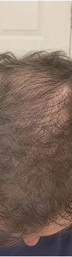 Josh N., 29, before: crown thinning