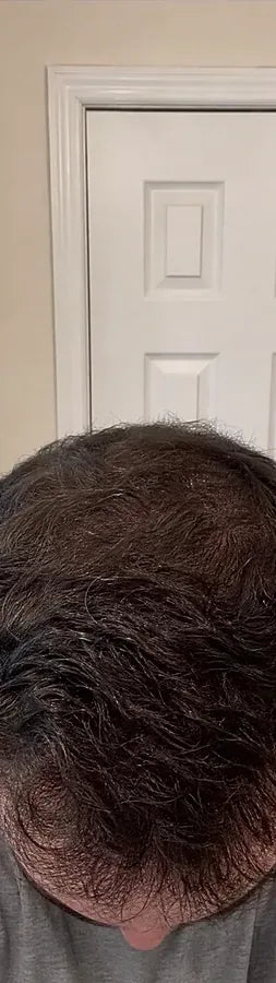 Derek F., 39, after: diffuse thinning