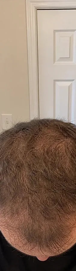 Derek F., 39, before: diffuse thinning