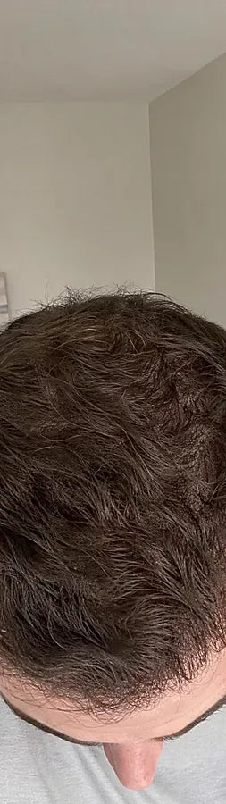 Owen B., 34, after: crown & part