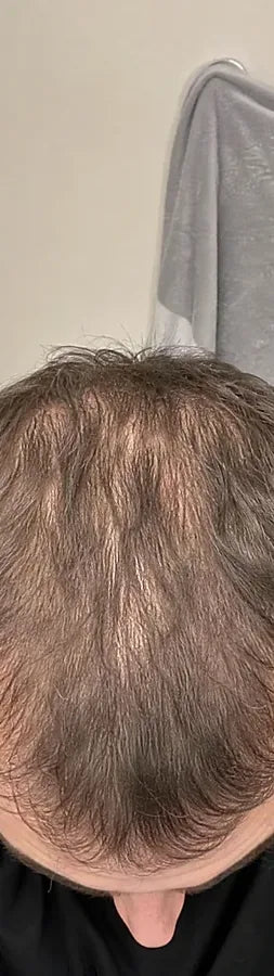 Owen B., 34, before: crown & part