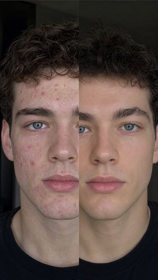 Before-and-after of inflammatory acne treated with Apex — clearer, calmer skin after 12 weeks
