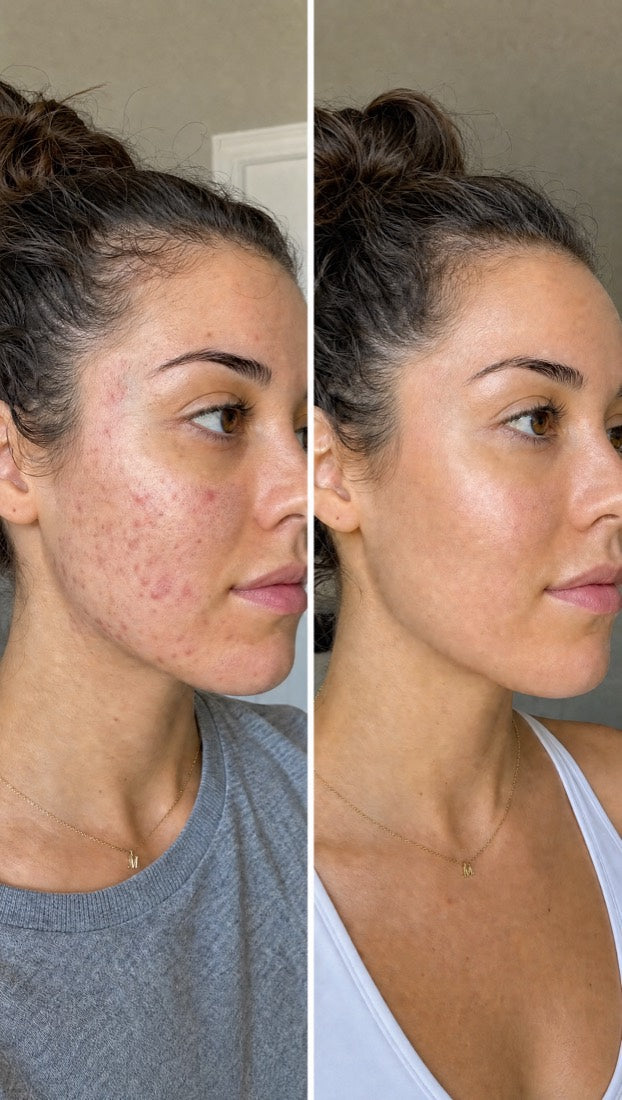 Before-and-after of hormonal acne treated with Apex — clearer skin and reduced inflammation after 12 weeks