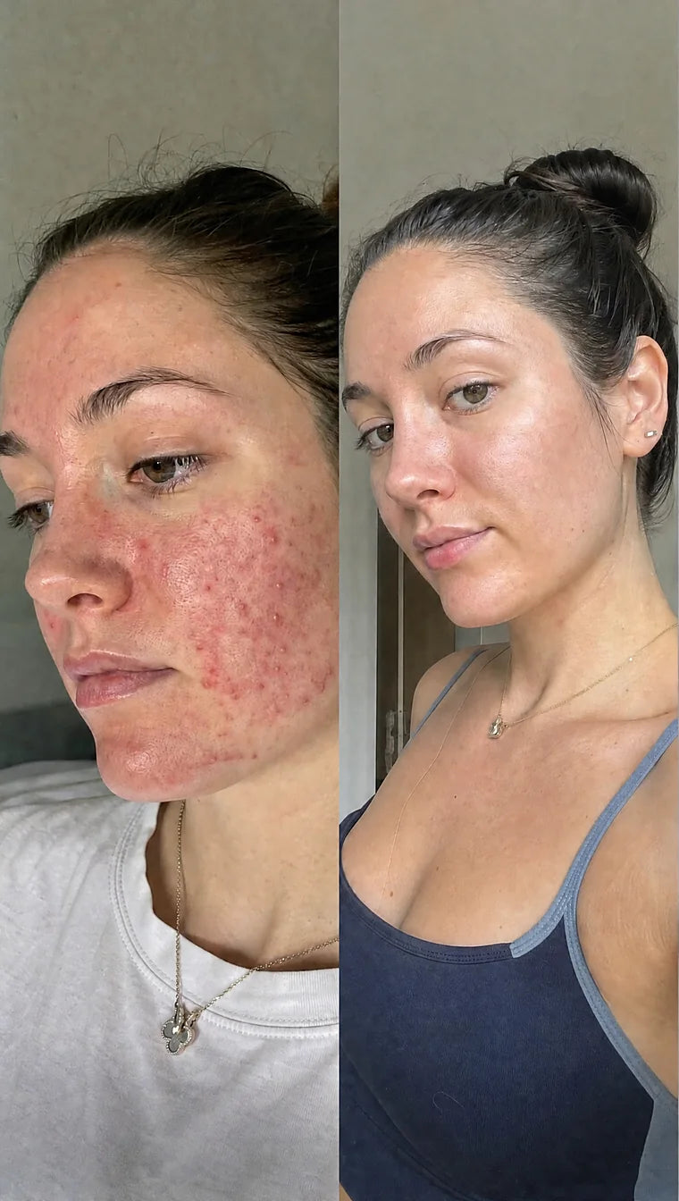 Rosacea before and after &mdash; Apex cold atmospheric plasma, result 11 of 12