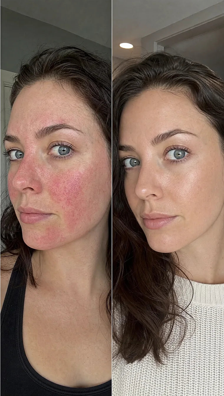 Rosacea before and after &mdash; Apex cold atmospheric plasma, result 2 of 12