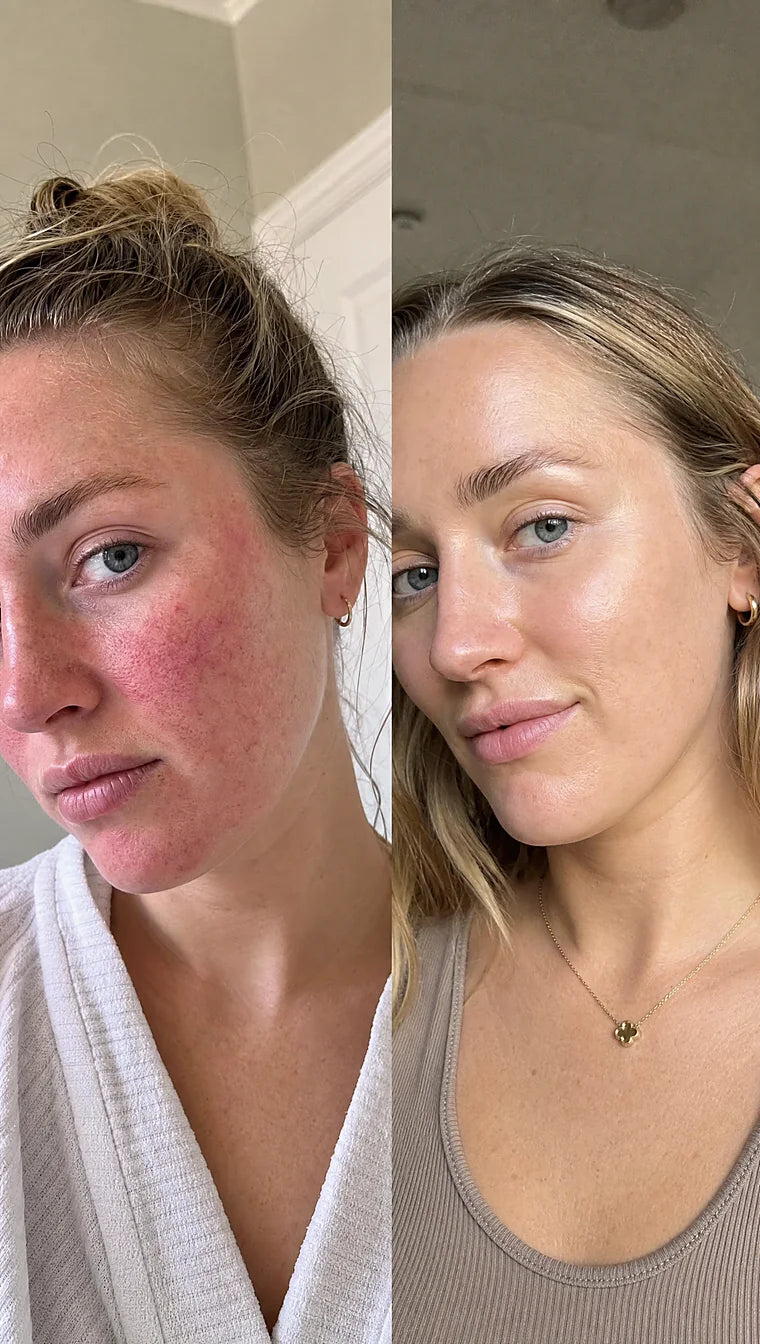 Rosacea before and after &mdash; Apex cold atmospheric plasma, result 3 of 12