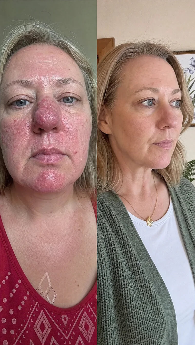 Rosacea before and after &mdash; Apex cold atmospheric plasma, result 5 of 12