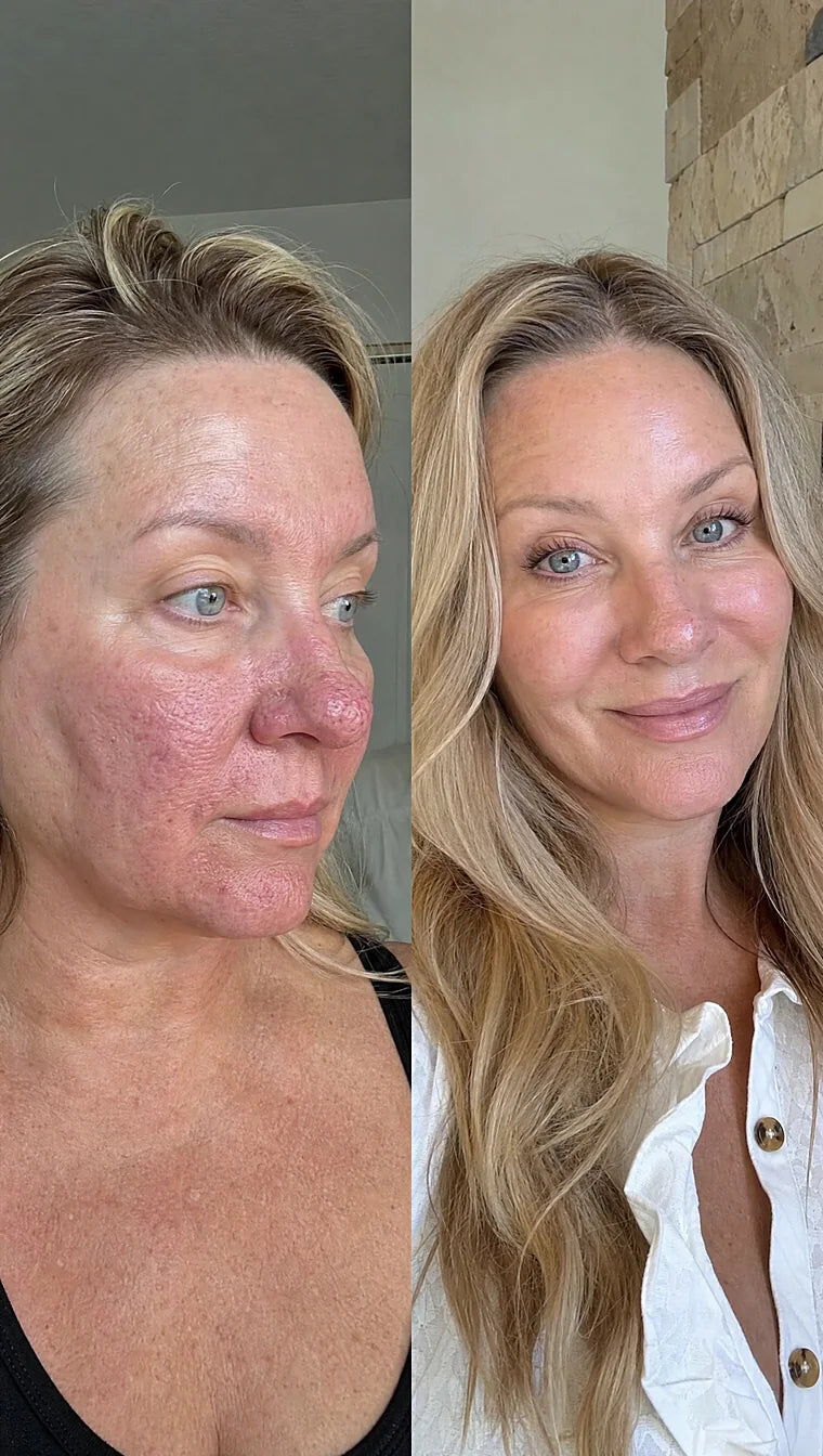 Rosacea before and after &mdash; Apex cold atmospheric plasma, result 6 of 12