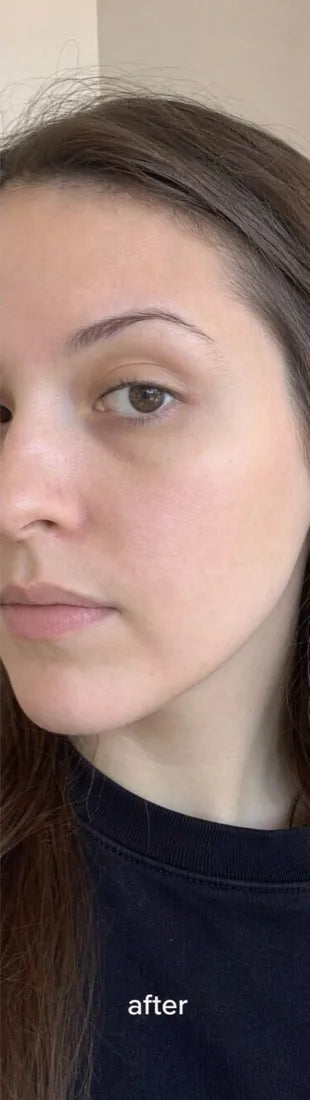 Customer, name withheld, after Day 60: atopic eczema