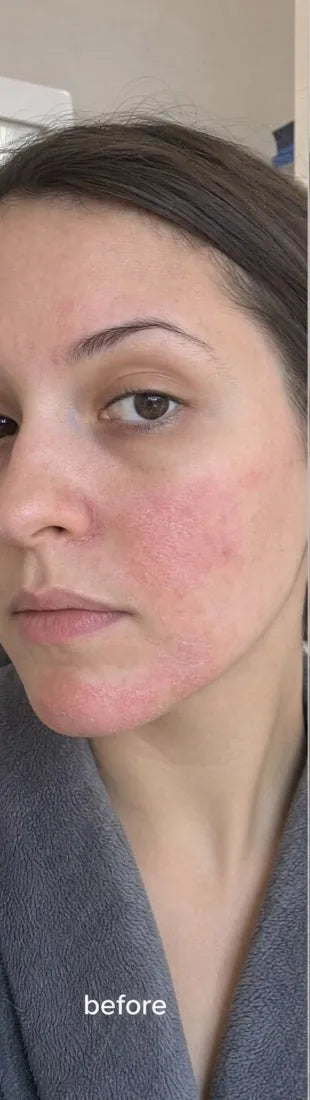 Customer, name withheld, before: atopic eczema
