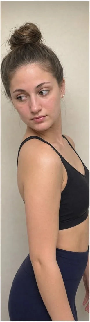 Daniella S., after Day 90: facial rash