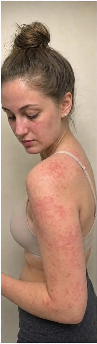 Daniella S., before: facial rash