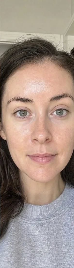 Olivia P., after Day 90: steroid rebound rash