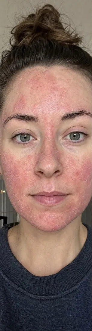 Olivia P., before: steroid rebound rash