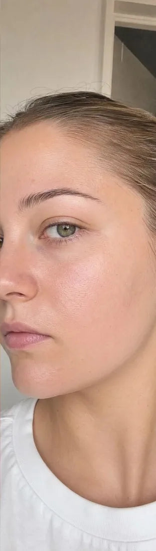 Sophie B., after Day 90: recurrent flare-ups