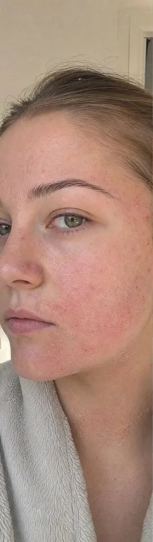 Sophie B., before: recurrent flare-ups