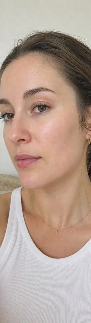 Rebecca H., after Day 90: rosacea
