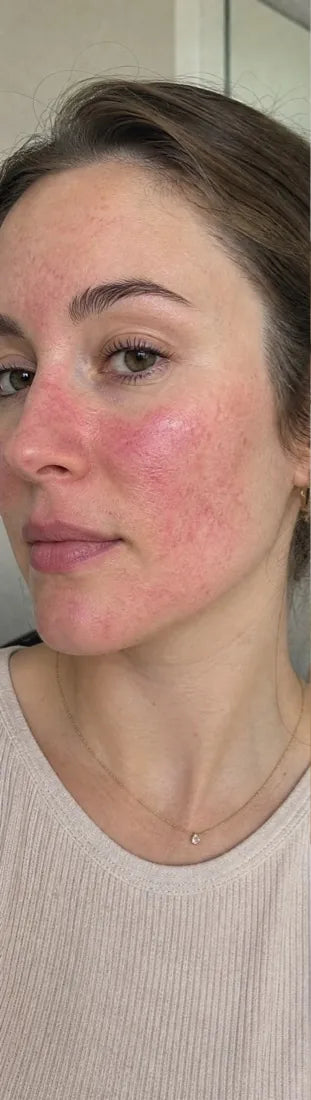 Rebecca H., before: rosacea