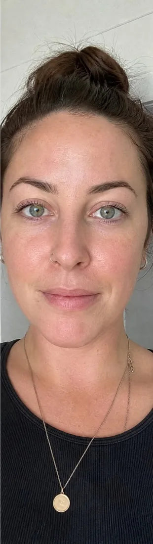Megan T., after Day 60: facial redness