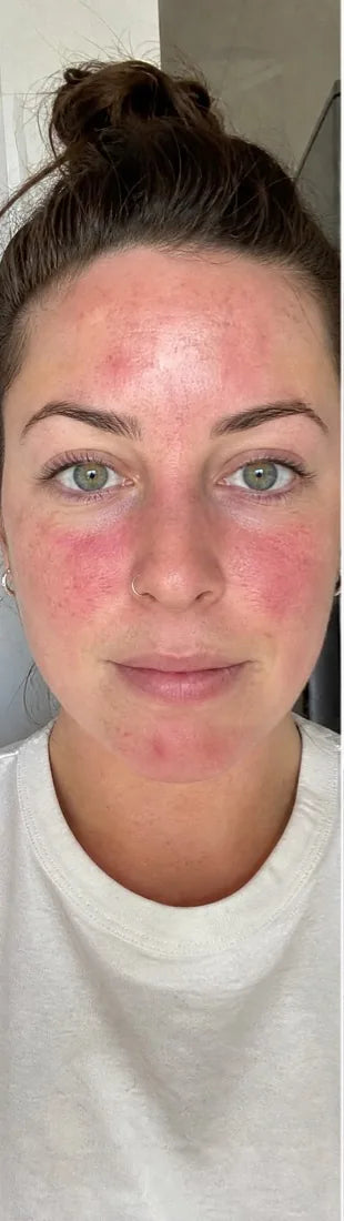 Megan T., before: facial redness