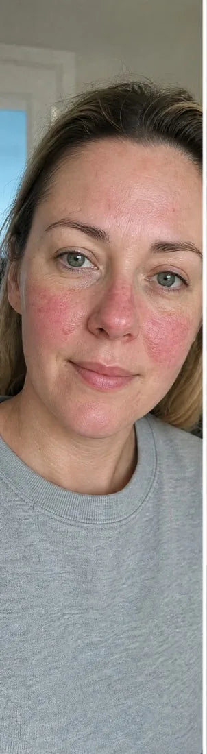 Caroline P., before: rosacea flushing