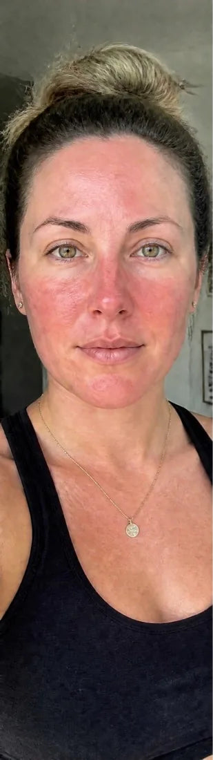 Danielle R., before: persistent redness