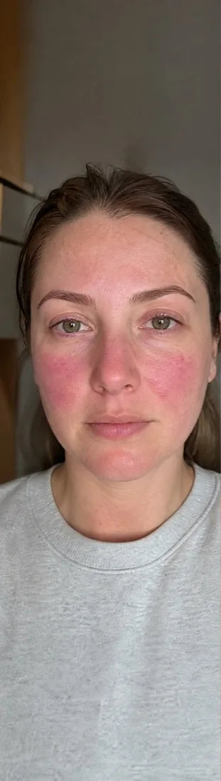 Hayley M., before: reactive redness