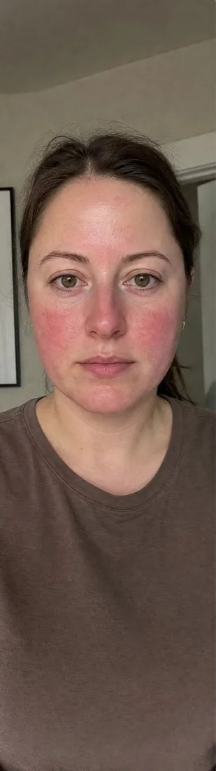 Nicole F., before: rosacea flare-ups