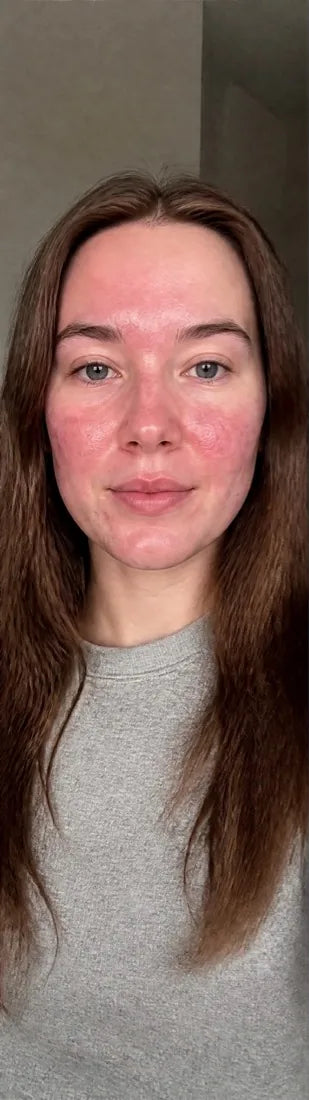 Erin C., before: flushing & redness