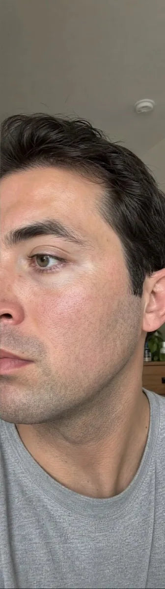 Daniel K., after Day 60: facial redness