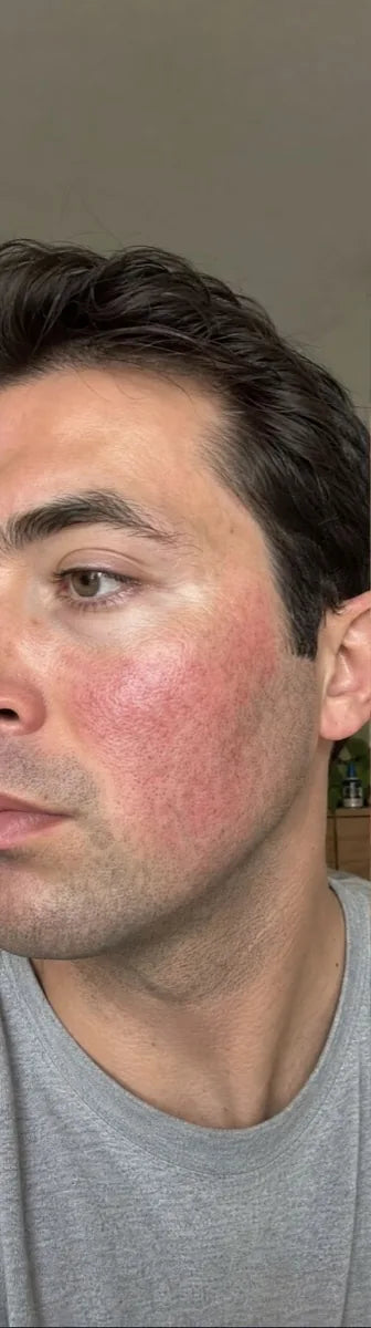 Daniel K., before: facial redness