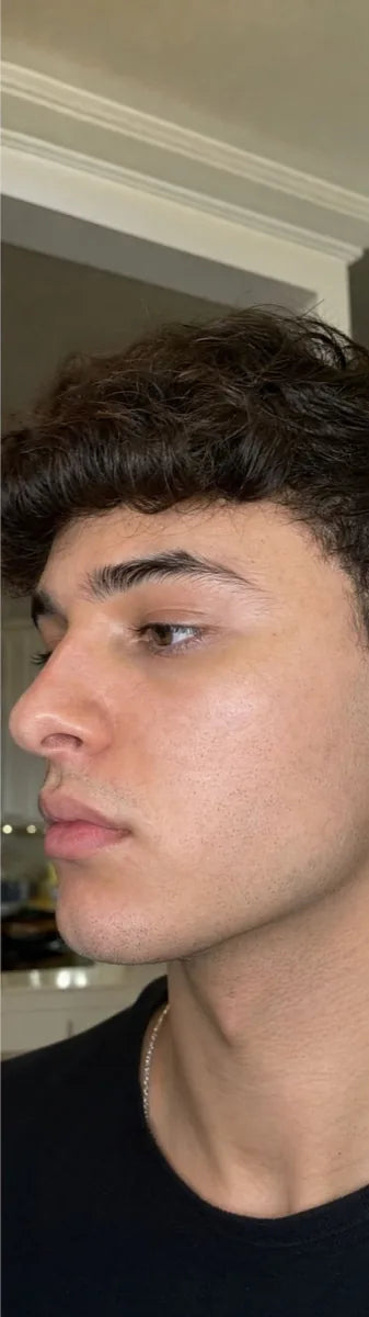 Ryan T., after Day 90: acne