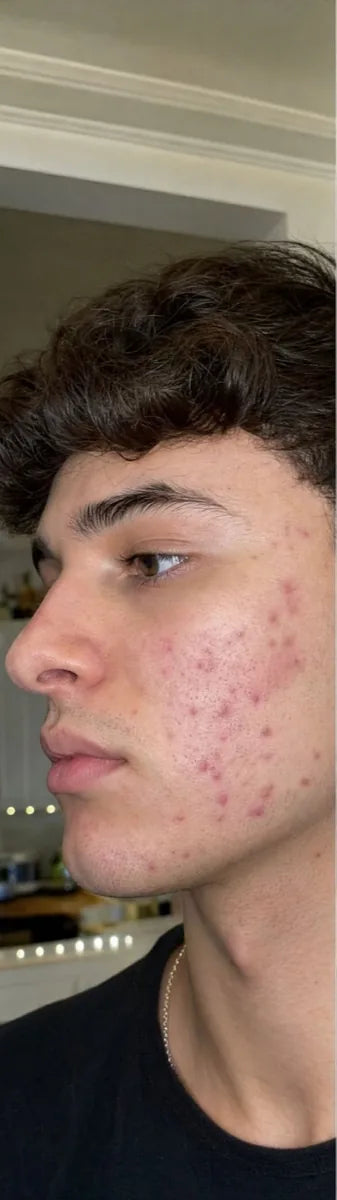 Ryan T., before: acne