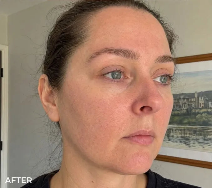 Michelle B., after Day 90: rosacea
