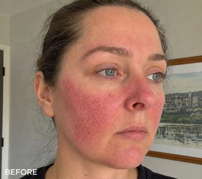 Michelle B., before: rosacea